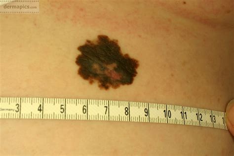 Melanoma Of The Skin Pictures And Clinical Information