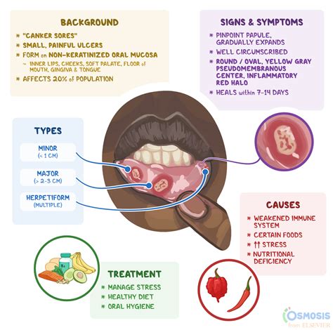 What Is A Canker Sore