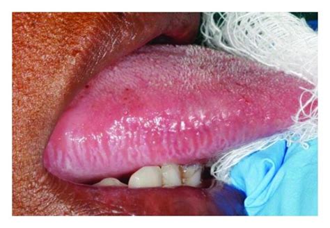 Mild Oral Hairy Leukoplakia Of The Lateral Border Of The Right Side Of