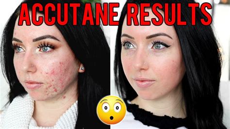 MY ACCUTANE JOURNEY MONTH RESULTS Before After Side Effects Would I Do It Again YouTube