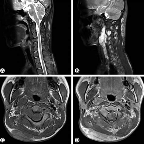 Preoperative MRI Of Cervical Spine T A And T Weighted B Sagittal Download Scientific