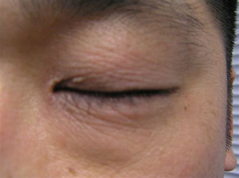 Eczema On Eyelid