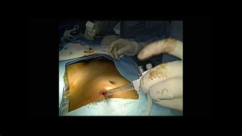 E Tep Repair Of A Direct And A Femoral Hernia Youtube