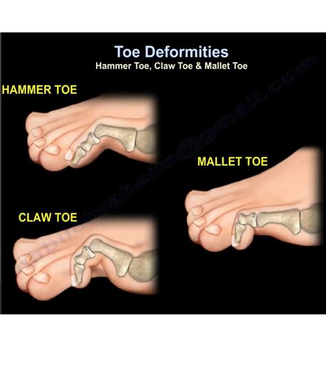 Toe Deformities Hammer Toe Claw Toe Mallet Toe