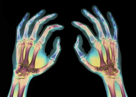 Coloured X Ray Of Healthy Human Hands Photograph By