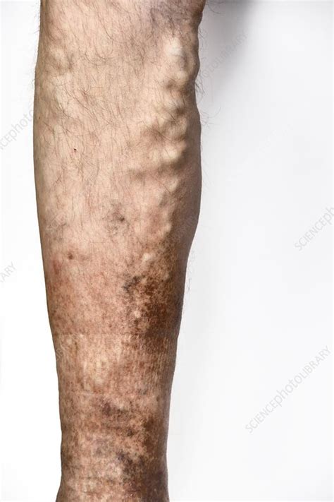 Varicose Veins And Eczema Stock Image C0165367 Science Photo Library