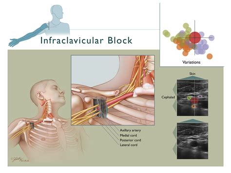 Nysora Infraclavicular Nerve Block