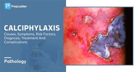 Calciphylaxis Causes Symptoms Risk Factors Diagnosis Treatment And