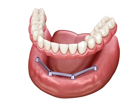 Removable Dental Implants Artistic Dentistry