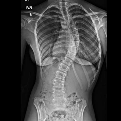Scoliosis The Sideways Spinal Curve That Could Be Causing Your