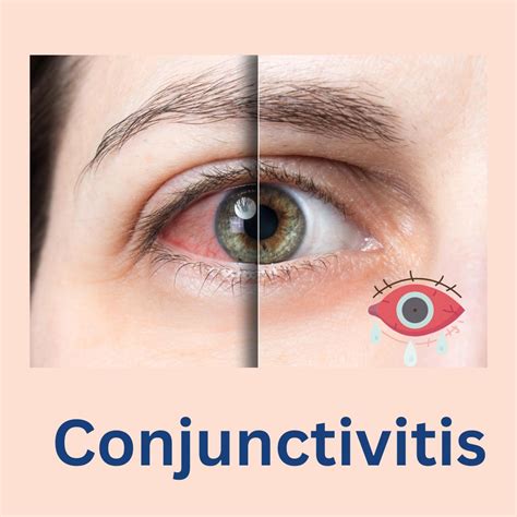 Homeopathic Treatment For Conjunctivitis Dr Vaseem Choudhary