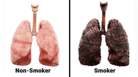 Nurse Explains What Smoking Every Day Does To Your Lungs