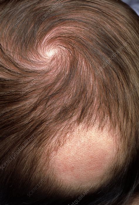 Bald Patch On The Back Of 3 Month Old Babys Head Stock Image M108