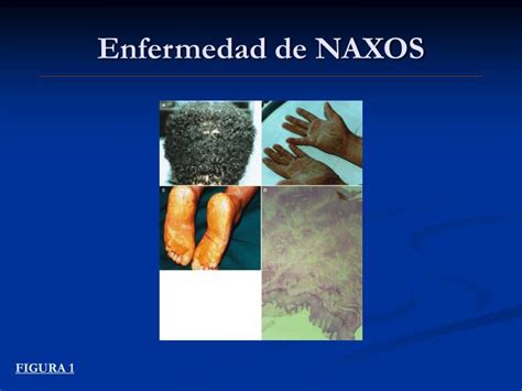 Ppt Enfermedad De Naxos Powerpoint Presentation Free Download Id965642