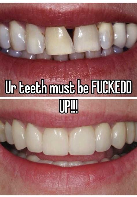 ur teeth must be fuckedd up