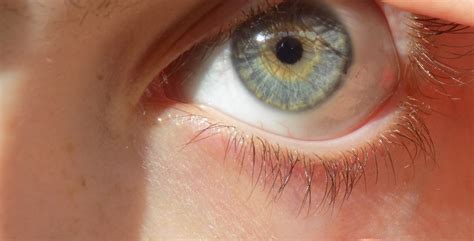 Central Heterochromia The Center Of The Eye Is Yellowbrown And The