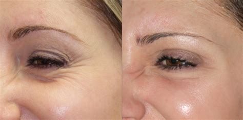 How To Get Rid Of Under Eye Wrinkles Overnight Fast With Laser
