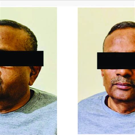 Figure1 Patient Presented With Swelling Over Left Side Of Face