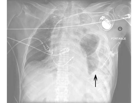 Diaphragmatic Rupture Secondary To Blunt Thoracic Trauma The Western