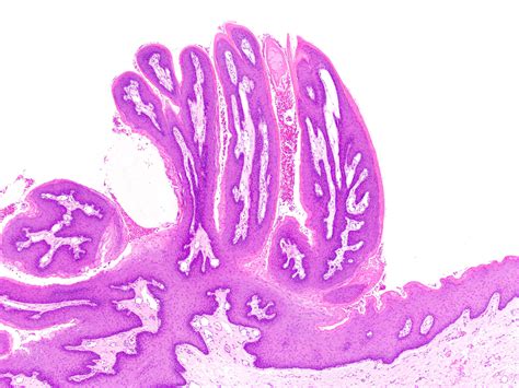 Pathology Outlines Squamous Papilloma