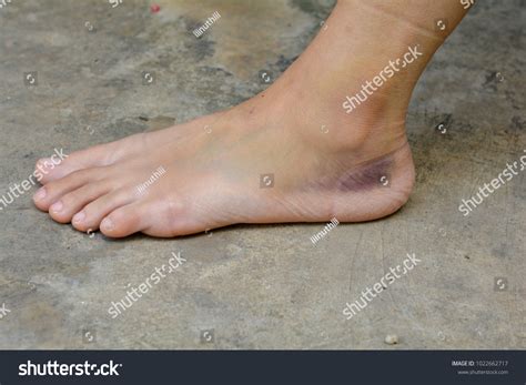 Ankle Sprained Bruise Contused Wound On Stock Photo 1022662717