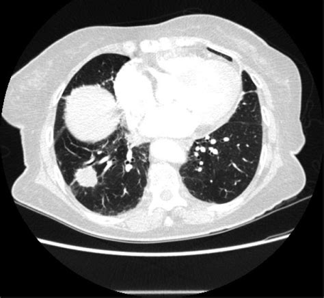 Axial Ct Image At The Level Of The Right Base Reveals A Spiculated