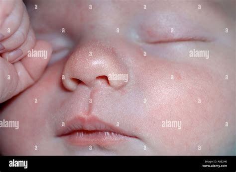 Milk Spots Or Milia On Babys Nose Stock Photo Alamy