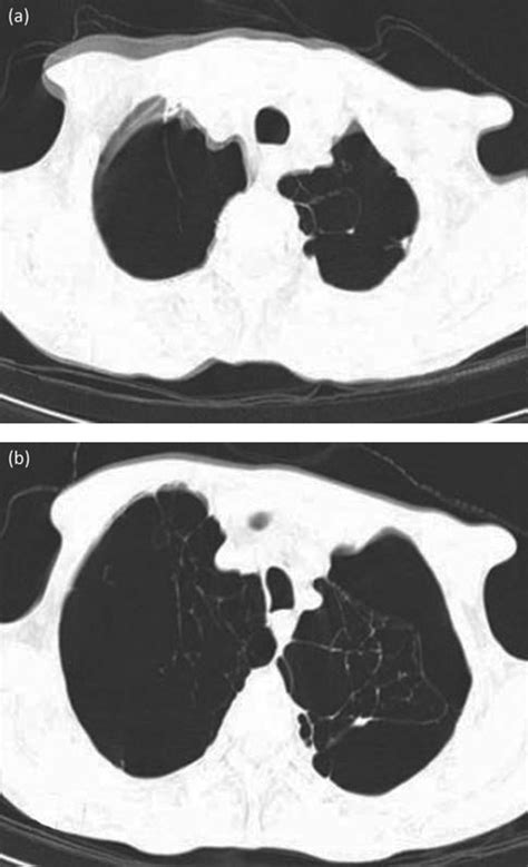 Vanishing Lung Disease In An Adult Misdiagnosed As Pneumothorax Rcp