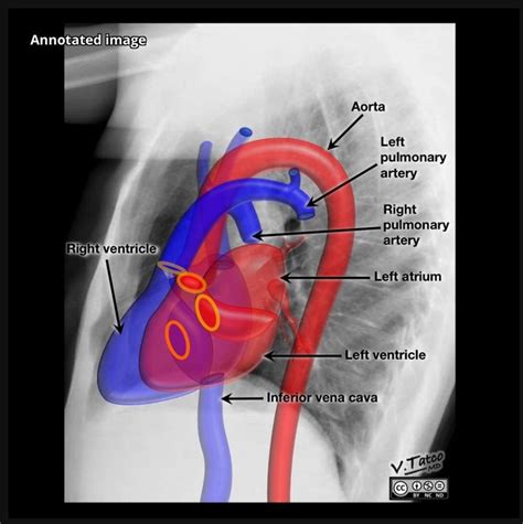 Heart X Ray Anatomy Radiology Medical School Essentials