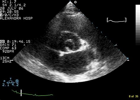 Incidental Diagnosis Of Unicuspid Aortic Valve In An Asymptomatic Adult