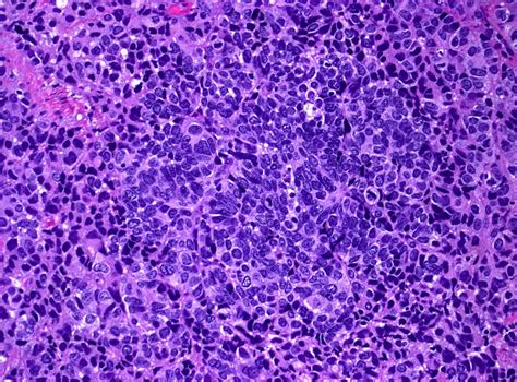 Pathology Outlines Large Cell Neuroendocrine Carcinoma