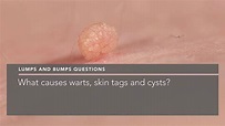 What causes warts, skin tags and cysts? - Penelope Pratsou | Reading ...