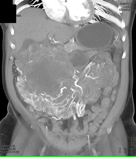 Large Abdominal Gist Tumor Gastrointestinal Case Studies Ctisus Ct