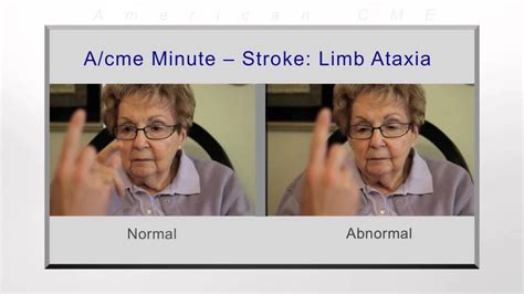 Acme Minute Stroke Limb Ataxia Youtube