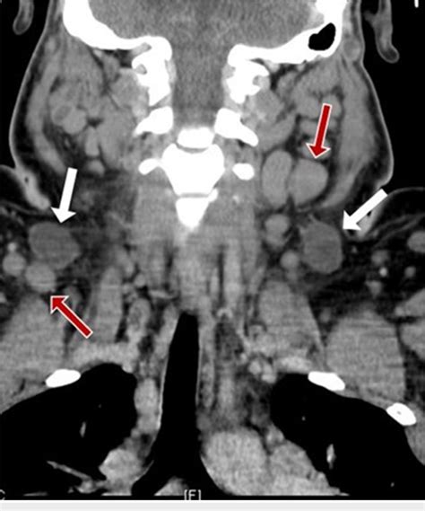 Computed Tomography Ct Of The Neck And Chest Marked Cervical