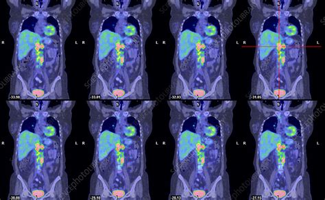 Non Hodgkins Lymphoma Ct And Pet Scans Stock Image M1340687