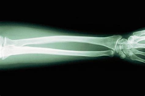 ¿cómo Se Origina El Cáncer De Huesos