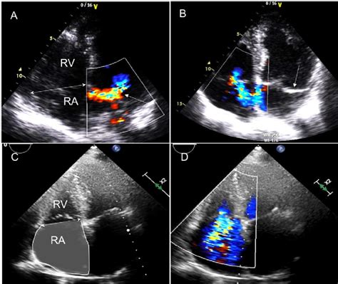 Rheumatic Tricuspid Valve Disease Quotes Trending