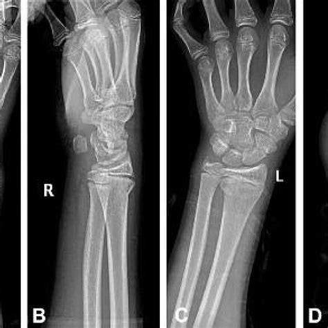 Pdf Bilateral Combined Fractures Of The Scaphoid And Distal Radius In
