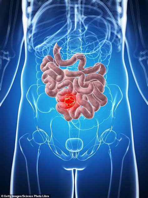 how a two part bowel cancer treatment could save patients from invasive surgery express digest