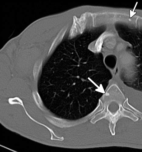 Castleman Disease Of The Thorax Clinical Radiologic And Pathologic