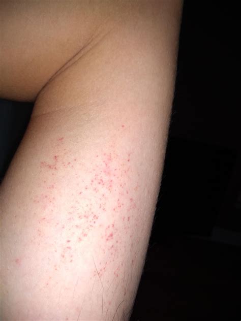 These Red Dots That Mysteriously Appeared On My Arm They Dont Hurt