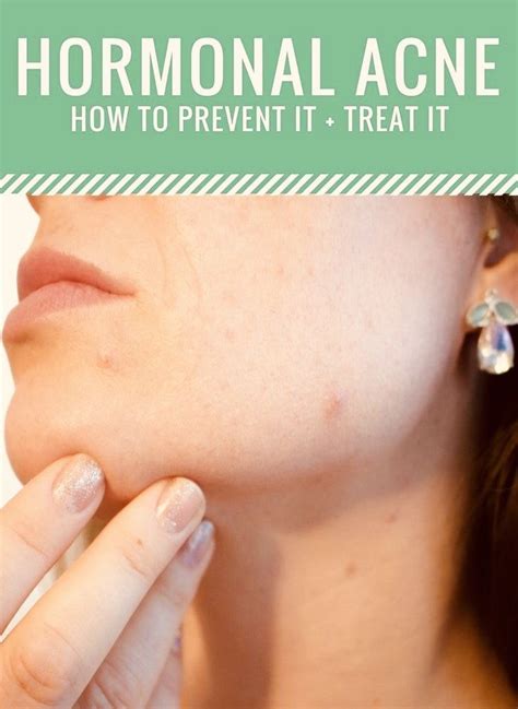 How To Prevent Hormonal Acne Chin Acne Hormonal Acne Clear Skin