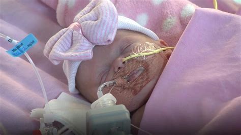 Baby Born With Heart Outside Body Doing Well Bbc News