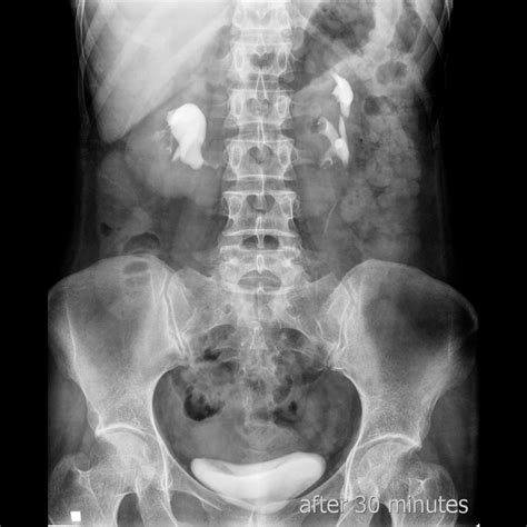 Horseshoe Kidney On Intravenous Pyelogram Image
