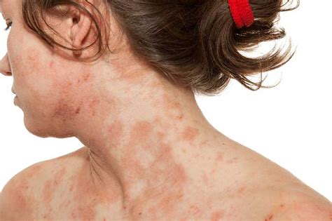 What Is Atopic Dermatitis In Adults Skin Care Geeks