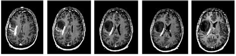 Ct Scan Images Slice Of An Astrocytoma Tumor Affected 41 Year Old Man