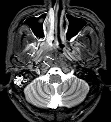 Essential Imaging Of The Nasopharyngeal Space With Special Focus On