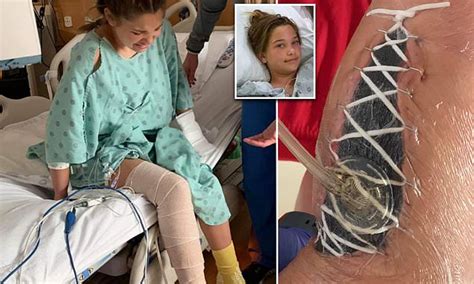 Girl 12 Is Lucky To Be Alive After Contracting Flesh Eating Bacteria Daily Mail Online