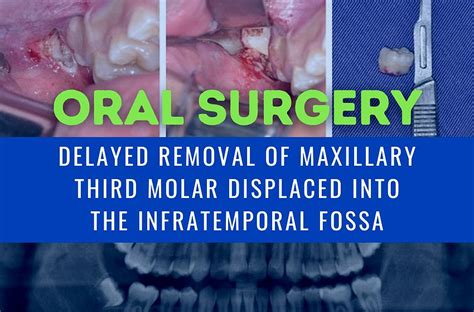 Pdf Delayed Removal Of Maxillary Third Molar Displaced Into The